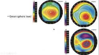 Corneal topography basic interpretation [upl. by Nnaassilem]