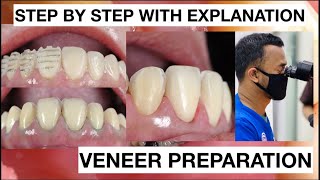 Step by Step Minimally Invasive Veneers Preparation  General Dentist Griya RR [upl. by Zed606]