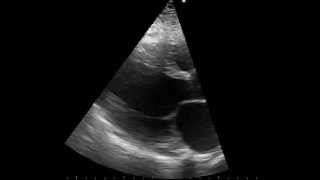 parasternal long axis echo of a patient with dilated cardiomyopathy [upl. by Lled438]