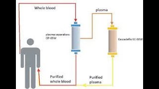 DFPP double filtration Plasmapheresis [upl. by Dirraj]