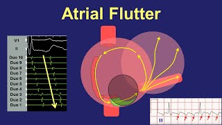 Atrial Flutter  Fundamentals of Diagnosis and Ablation [upl. by Phillane]