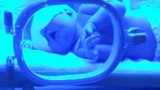 Jaundice treatment  Blue Light Special [upl. by Rea]