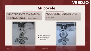 MUCOCELEMUCOUS EXTRAVASATIONSUPERFICIAL MUCOCELE imagebasedquestion bdshorts neetmds2023 [upl. by Acyssej]