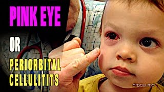 LIVE DIAGNOSIS Pink Eye or Periorbital Cellulitis  Dr Paul [upl. by Percy55]