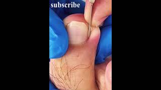 Best Satisfying Ingrown Toenail Removal [upl. by Hepsiba]