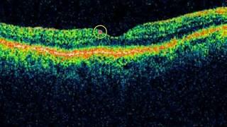 Mastering OCT Interpretation with Dr Mark Friedberg [upl. by Landrum]