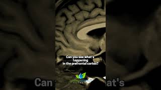 Prefrontal Cortex The Ultimate Brain Upgrade [upl. by Riccio]