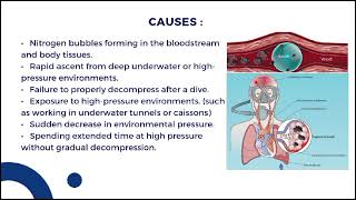 Caissions Disease  Also known as Decompression Sickness [upl. by Anniram]