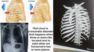 Flail chest  looks like this [upl. by Blasius]