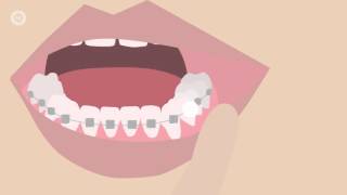 How To Deal With Braces Discomfort  Whats Normal Whats Not amp What To Do [upl. by Sension]