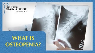 Fort Worth Brain and Spine Institute  What is Osteopenia [upl. by Buatti]