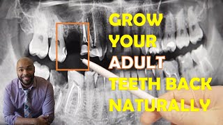 How To Grow Your ADULT Teeth Back Naturally 🦷 [upl. by Suisyola]