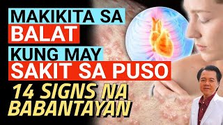 Makikita sa Balat kung May Sakit sa Puso 14 Signs na Babantayan  By Doc Willie Ong [upl. by Arbe]