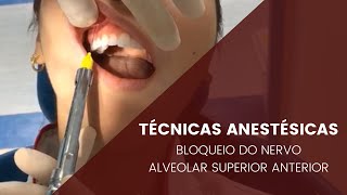 Técnicas anestésicas bloqueio do Nervo Alveolar Anterior [upl. by Swetiana]