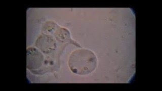 Trichomonas hominis con Blastocystis fagocitados e intento de fagocitosis de otro [upl. by Gnanmos]