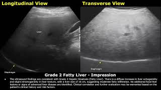 Grade 2 Fatty Liver Ultrasound Report Example  Diffuse Hepatic Steatosis Sonography  Abdominal USG [upl. by Ardnekahs]