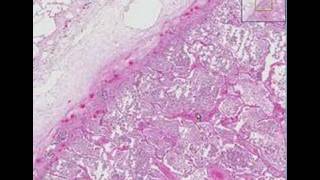 Histopathology Lung Lobar pneumonia [upl. by Harold303]