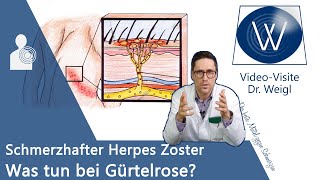 Herpes Zoster Gürtelrose durch WindpockenViren 😬 Schmerzen amp Ausschlag  Entstehung amp Therapie [upl. by Dacie]