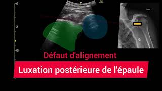 Luxation Postérieure de lÉpaule Échographie Glénohumérale Posterior shoulder dislocation [upl. by Bran519]