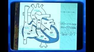 congenital heart disease ASD 1 [upl. by Ribal]