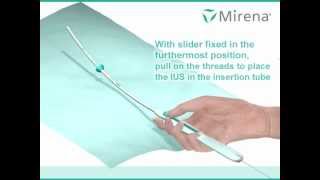 Mirena IUS insertion procedure animated [upl. by Magner219]