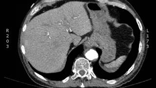 Ruptured AAA axial CT JETem 2017 [upl. by Elleneg]