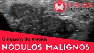 Ultrassom da tireóide  Nódulos malignos  Dr Jônatas Catunda [upl. by Pentheas]