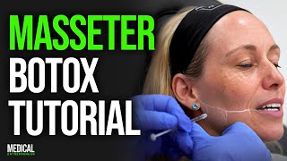 Masseter Botox for Facial Slimming and Migraines  Full Procedure Demonstration [upl. by Scornik]