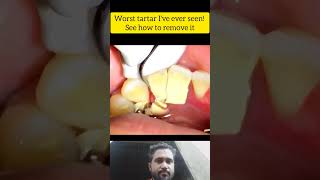 Worst tartar Ive ever seen See how to remove ittartar tartarremoval shorts shortvideo viral [upl. by Mcnamee135]