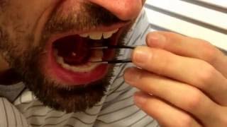 Removing my own salivary gland stone [upl. by Ardyaf]