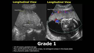 Placental Grading On Ultrasound  Grade 0 1 2 3 Placenta USG [upl. by Ijuy]