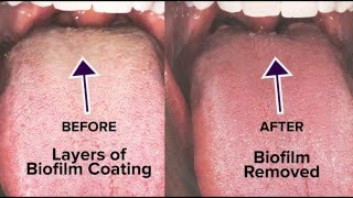 Tongue Rejuvenation The ANSWER to Fixing Chronic Bad Breath amp Halitosis [upl. by Amehsyt284]