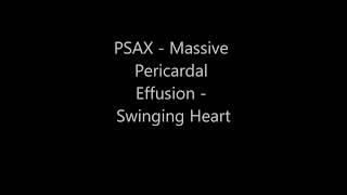 Massive Pericardial Effusion  Swinging Heart  Transthoracic Echocardiogram TTE [upl. by Plath]