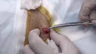 Large Epidermoid Cyst Removal Cysts Whiteheads Dermatolgy Videos [upl. by Marylynne]