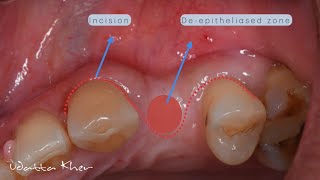 Buccal Roll Flap [upl. by Anika536]