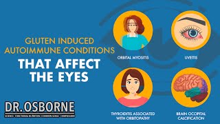 Gluten induced autoimmune diseases that affect the eyes [upl. by Salene]