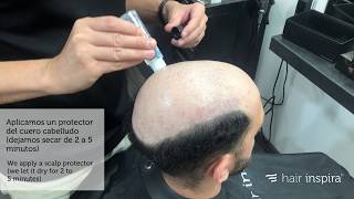 Alopecia Pérdida de pelo Causas tipos tratamiento [upl. by Angy]