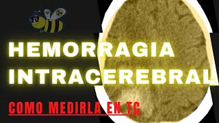 ⚠️▶️✔️COMO MEDIR UNA HEMORRAGIA INTRACEREBRAL EN TOMOGRAFÍA❓ [upl. by Neelyam248]