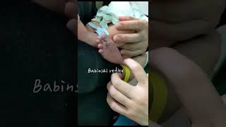 Babinski reflex in infants [upl. by Rhpotsirhc]