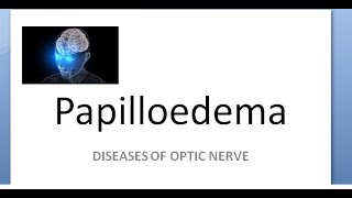 Ophthalmology Papilledema amaurosis fugax sometimes loss of vision cant see Hayreh theory [upl. by Imer]