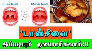 டான்சில்க்கு எளிய வீட்டு வைத்தியம் Tonsils and Adenoids treatment [upl. by Mik]