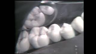 688 Class II Mesio Occlusal Cavity Preparation for Amalgam [upl. by Onia]