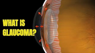 Glaucoma Signs and Treatment 3D Animation [upl. by Aineles]