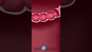 Colonoscopy Lower Endoscopy  PreOp® Patient Education amp Patient Engagement shorts [upl. by Marston]