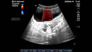 Case 106  Ureteral jets [upl. by Sterner]