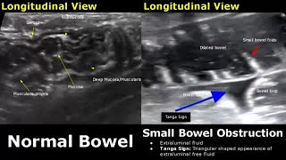 Abdominal Ultrasound Normal Vs Abnormal Images  Liver Gallbladder Pancreas Kidney Hernia USG [upl. by Day256]