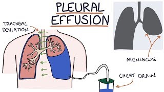 Understanding Pleural Effusions [upl. by Tanny]