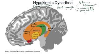 Hypokinetic Dysarthria  examples and tutorial [upl. by Eduard102]