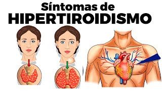 Síntomas de HIPERTIROIDISMO causas diagnóstico y tratamiento [upl. by Nhguavoj248]