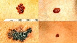 What Does Melanoma Look Like  Skin Cancer [upl. by Ahsyle]